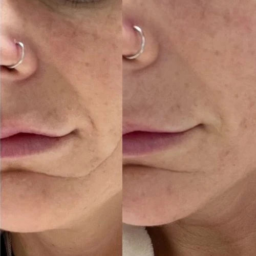 Corners of Eyes & Mouth Facial Patches