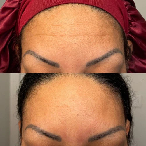 Forehead & Between the Eyes Facial Patches