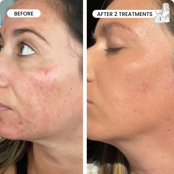 Micro-Infusion Facial Micro-needling System