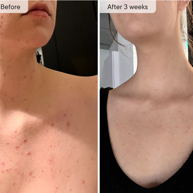 Neck & Décolletage LED System Red Light Neck & Chest Mask