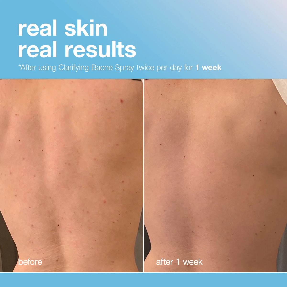 Clarifying Bacne Spray