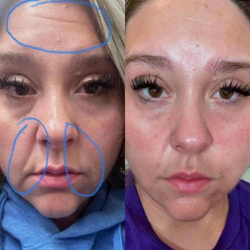 Corners of Eyes &amp; Mouth Facial Patches