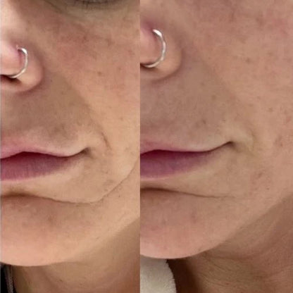 Corners of Eyes &amp; Mouth Facial Patches