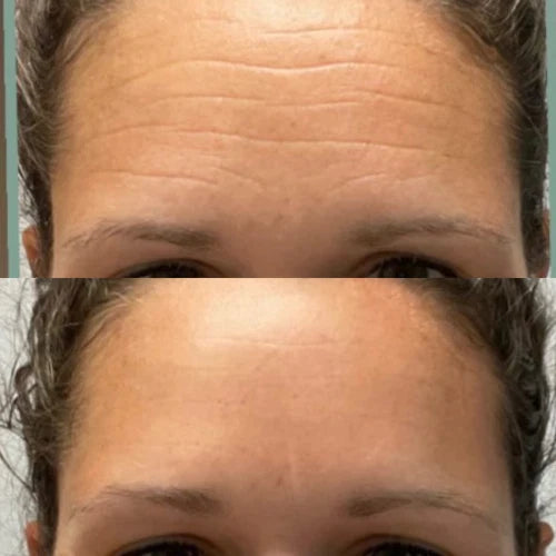 Forehead &amp; Between the Eyes Facial Patches