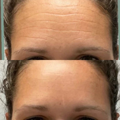 Forehead &amp; Between the Eyes Facial Patches