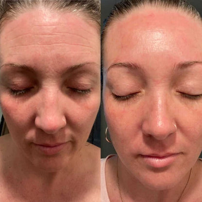 Forehead &amp; Between the Eyes Facial Patches