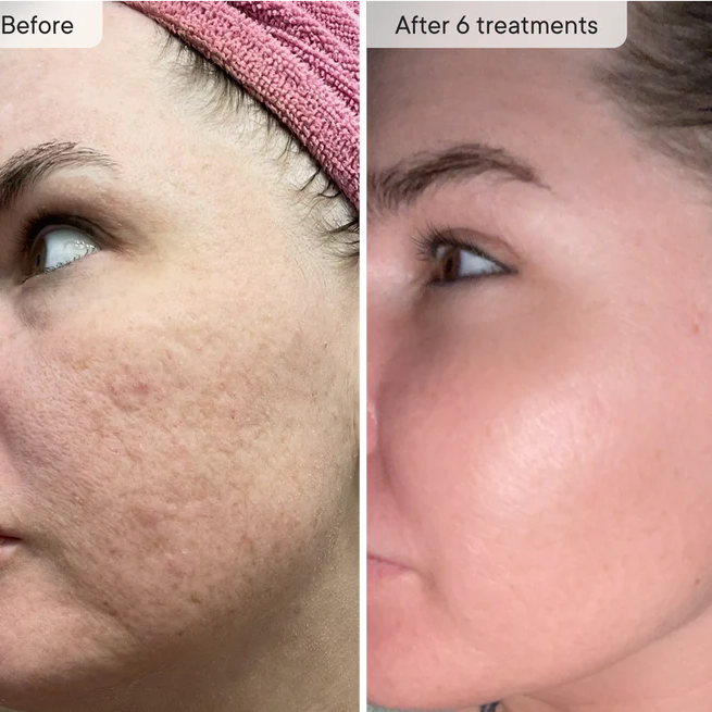 Micro-Infusion Facial Micro-needling System