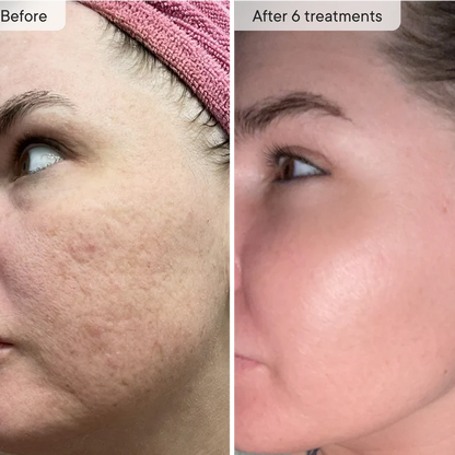 Micro-Infusion Facial Micro-needling System