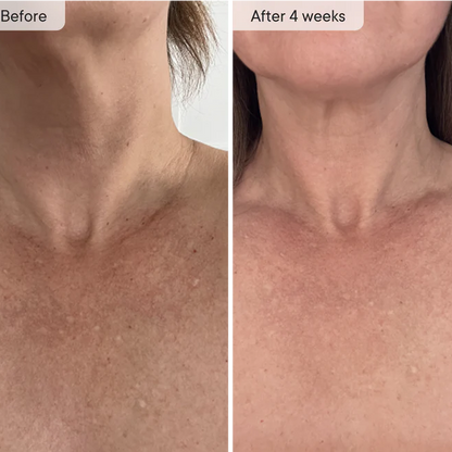 Neck &amp; Décolletage LED System Red Light Neck &amp; Chest Mask