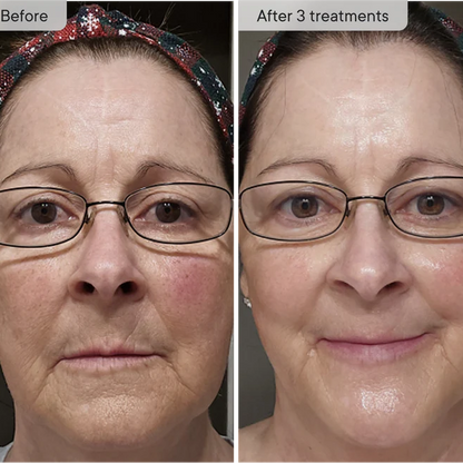 Micro-Infusion Facial Micro-needling System