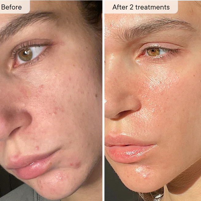 Micro-Infusion Facial Micro-needling System