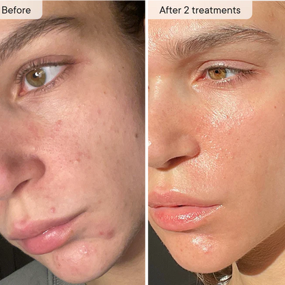 Micro-Infusion Facial Micro-needling System