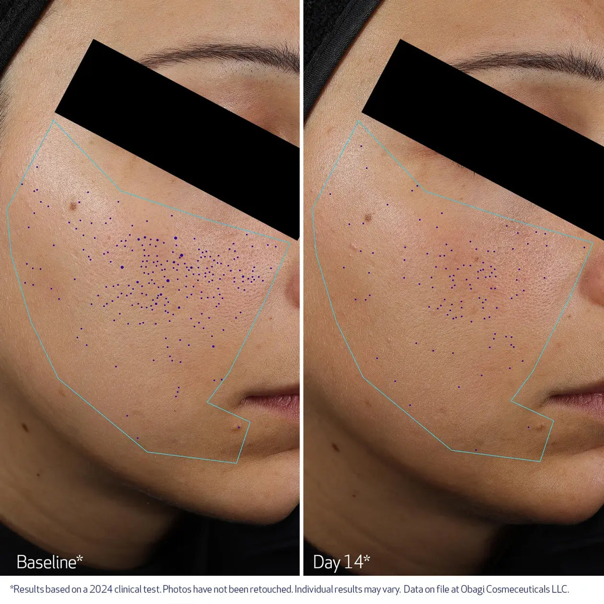 CLENZIDERM M.D.® Pore Therapy Exfoliating BHA Toner