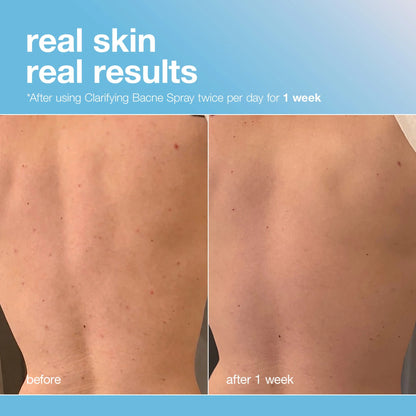 Clarifying Bacne Spray